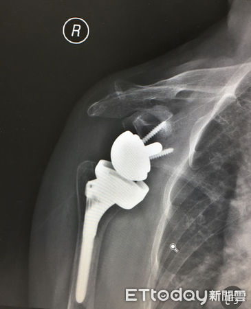 ▲患者接受反式人工肩關節置換手術，肩膀已不再疼痛。（圖／記者許宥孺翻攝）