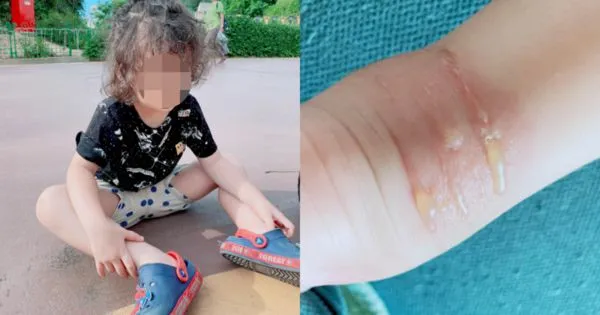 網紅「鰻魚家家酒」分享3歲半兒子因膠鞋引發蜂窩性組織炎的故事，提醒爸媽們要多注意。（翻攝自鰻魚家家酒臉書）