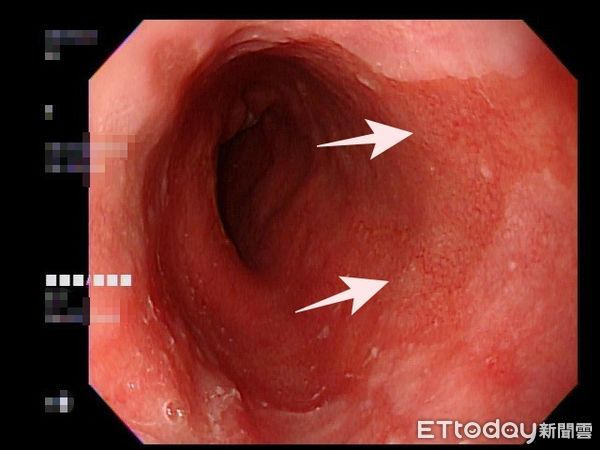 ▲火燒心！男子食道佈滿鮭魚斑，醫點名：4類人注意。（圖／亞大附醫提供）