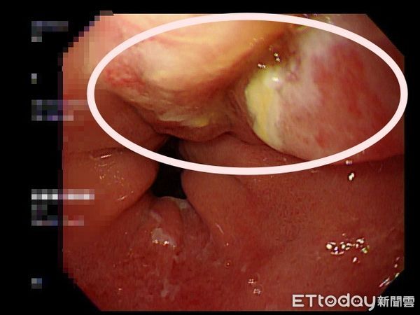 ▲火燒心！男子食道佈滿鮭魚斑，醫點名：4類人注意。（圖／亞大附醫提供）