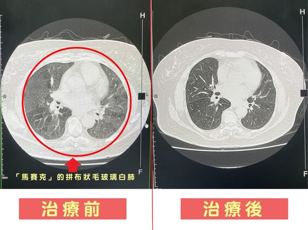 ▲▼患者X光兩側肺葉裡，密佈著黑白相間的拼布狀陰影。（圖／烏日林新醫院提供）