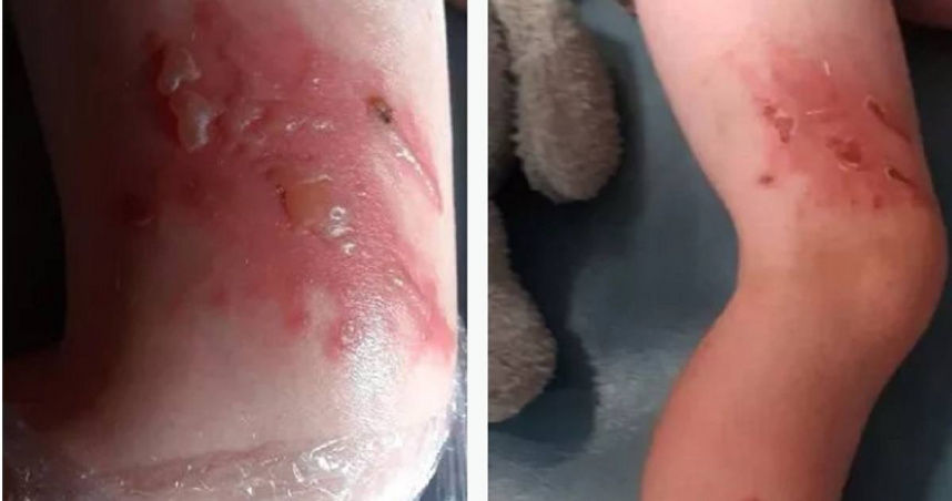 碰到最危險植物！4歲女童冒「黑色水泡」傷疤不會好　醫：跟燒傷一樣嚴重