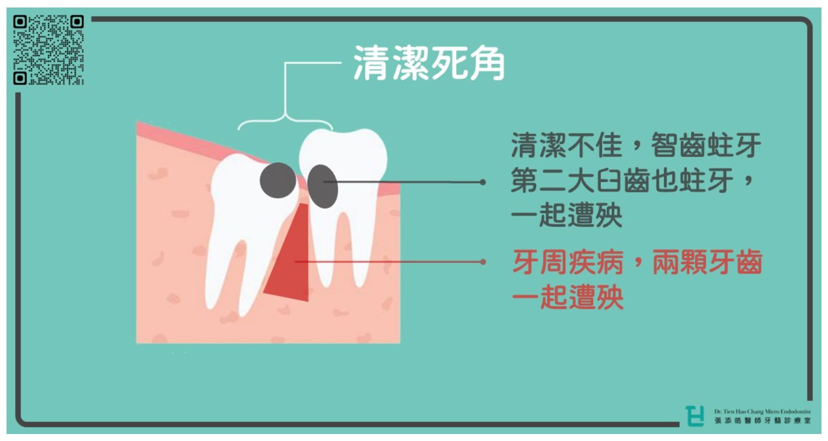 智齒的清潔死角，會造成蛀牙、牙周疾病。（圖／張添皓醫師牙髓診療室提供）