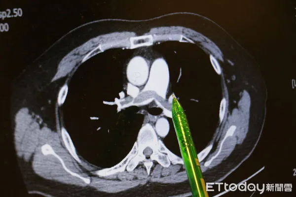 ▲男子不菸不酒竟雙側肺栓塞險丟命，醫師揭2壞習慣釀禍。（圖／慈濟醫院提供）
