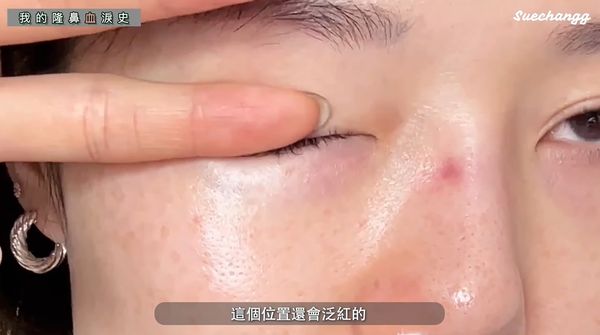 ▲Sue Chang第一次整鼻失敗後，留下無法回復的紅色疤痕。（圖／翻攝自YouTube／suechangg）