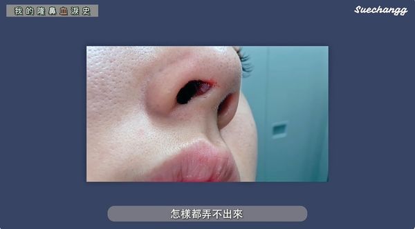 ▲Sue Chang第二次整鼻也失敗，假體穿出傷口。（圖／翻攝自YouTube／suechangg）