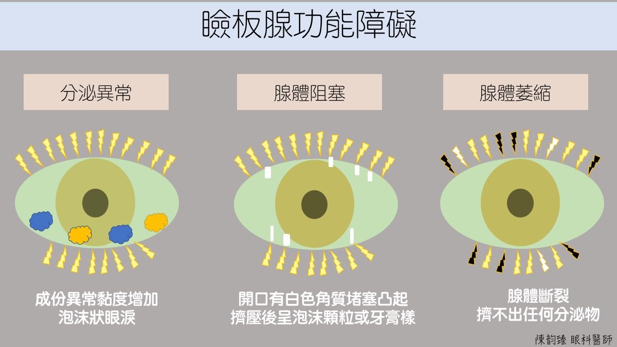 ▲▼瞼板腺功能障礙。（圖／截自陳韵臻醫師個人網站）