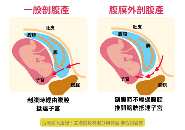 ▲▼一般剖腹產與腹膜外剖腹產差異。（圖／台灣女人連線提供）