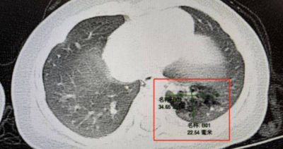 4個月嬰兒咳嗽不止 竟是因「多長了一個肺」