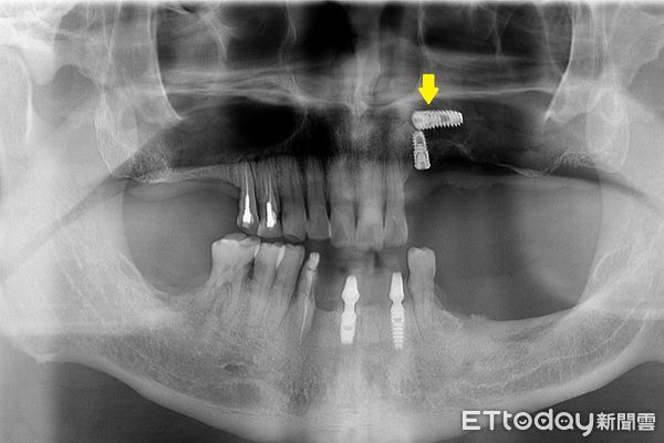人工牙根意外掉入鼻子。（圖／台北慈濟醫院提供）