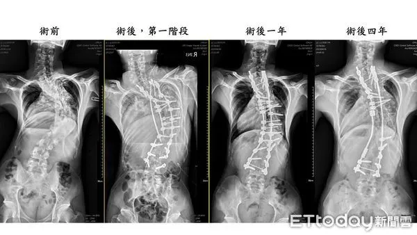 ▲中醫大附醫採用「3D導航輔助脊椎畸形截骨矯正手術」，治療駝背且嚴重脊椎側彎的緬甸「龜背少年」番玉磊 。（圖／記者蔡佩旻翻攝）