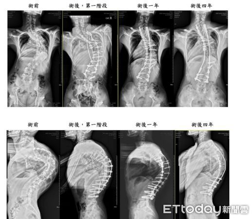 ▲緬甸「龜背少年」番玉磊成功手術後每年定期追蹤，均維持良好狀態。（圖／記者游瓊華翻攝）