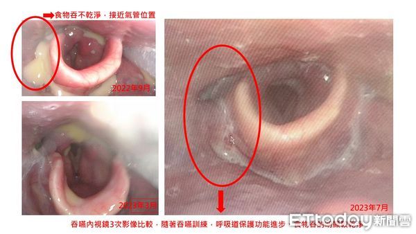 ▲邱爺爺吞嚥內視鏡3次影像比較。（圖／門諾醫院提供，下同）