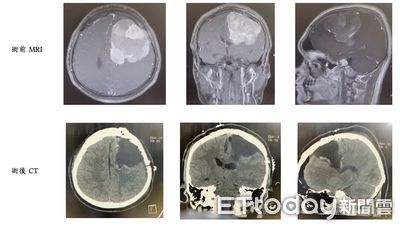 22歲男突「無法拿筷子」右半身無力!醫驚見「長了7公分大腦瘤」