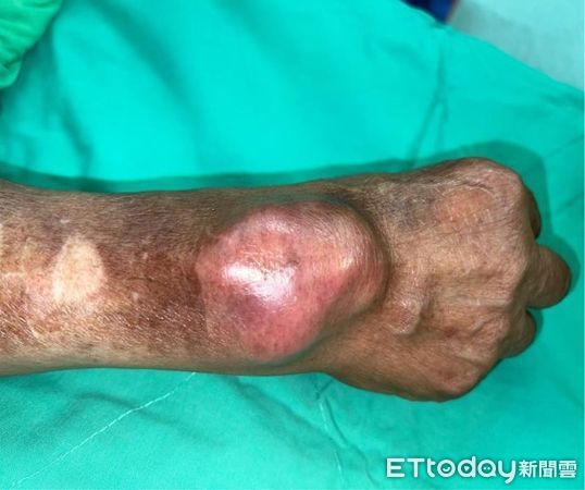 ▲農夫右手臂到手腕有一個大約6X5公分的紅色腫塊，住進整型外科病房治療。（圖／慈濟醫學中心提供，下同）
