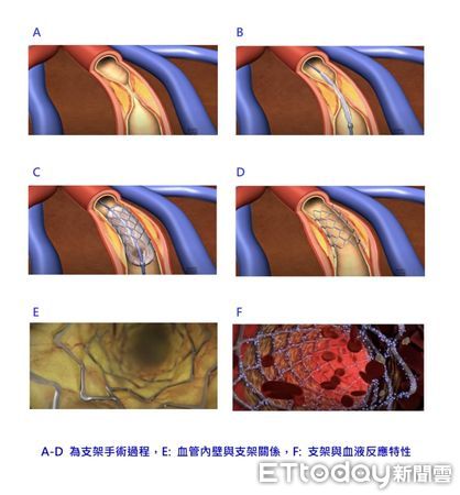 ▲成大材料科學及工程學系特聘教授洪飛義團隊結合鎂（Mg）與聚乳酸塑料（PLA），研發出全新材料PLAM，為台灣積極發展醫材科技注入強心針。（圖／記者林東良翻攝，下同）