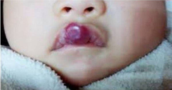 在嬰兒和兒童中更為常見的「毛細血管瘤」。（示意圖／翻攝　微博）