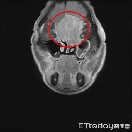 ▲黃先生腫瘤已長到6公分，從大腦額葉到雙側眼框到鼻腔上部，佔據整個前顱底並侵蝕到鼻樑骨。（圖／慈濟醫學中心提供，下同）