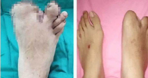 12歲女孩罹怪病長出「浩克腳趾」　她被截肢卻笑：終於能穿鞋了