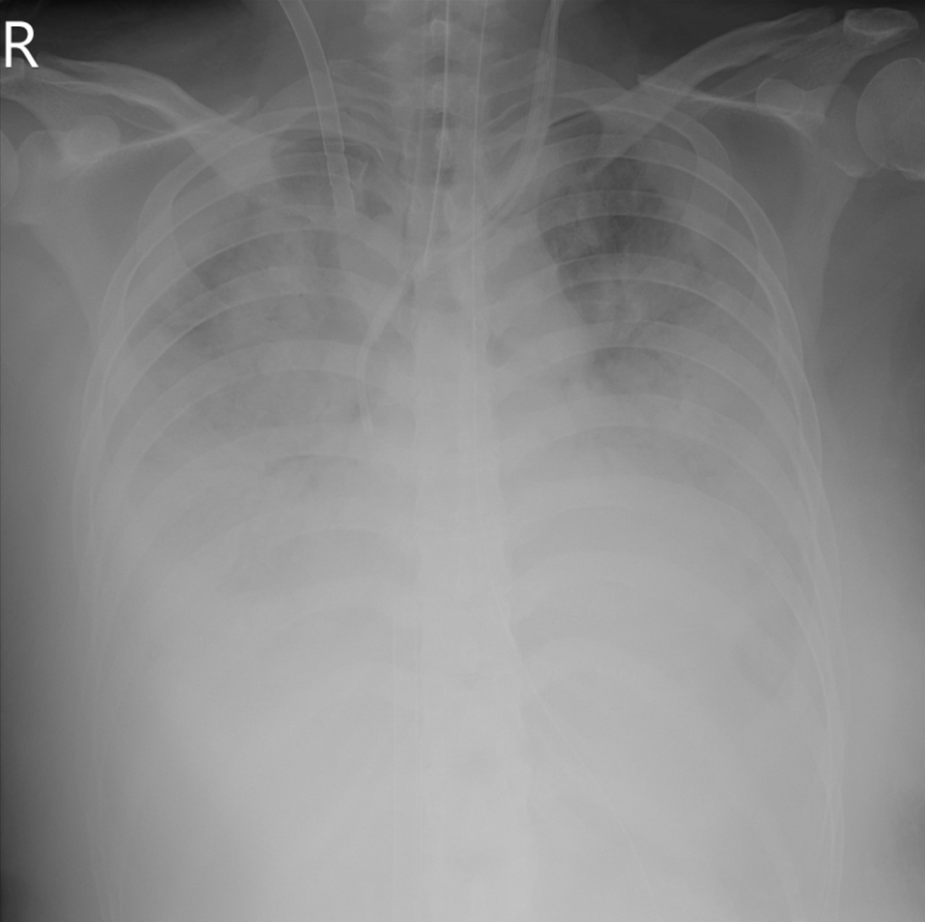 ▲▼患者染A流，從X光可見嚴重肺炎，兩邊肺部白掉。（圖／烏日林新醫院提供）
