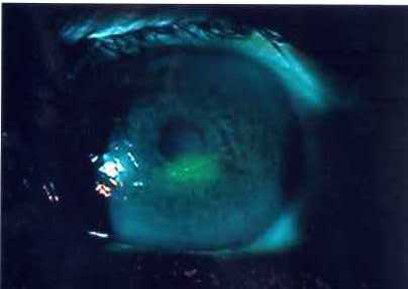 ▲第一天左眼中間瞳孔偏下，有一塊約0.4x0.3mm大小的不規則撕裂傷。（圖／洪啟庭醫師提供）