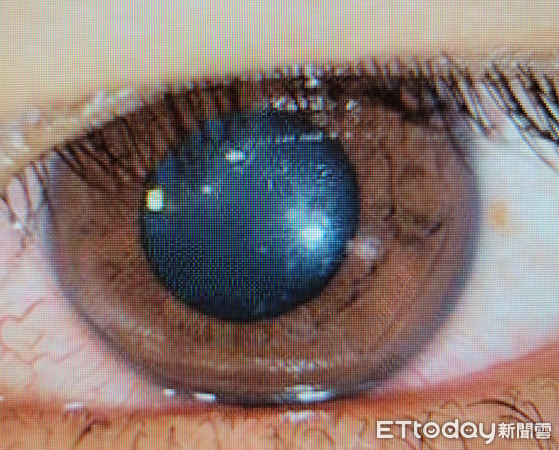 ▲陳小小解積極治療2周後，左眼角膜細胞將近修復，最佳視力也回0.9。（圖／洪啟庭醫師提供）