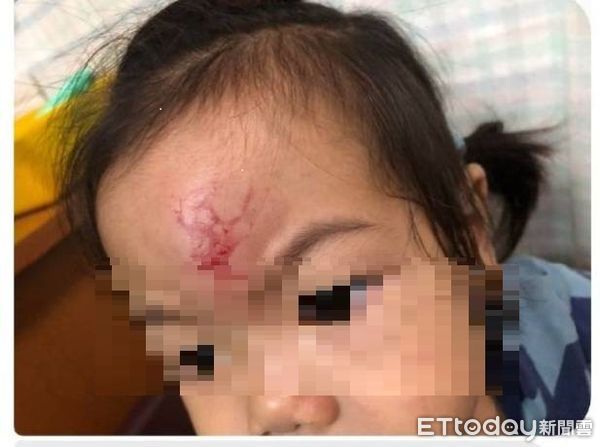 ▲台中十九甲健康公園隱藏危機，女孩玩耍竟摔頭腫大包。（圖／市議員江和樹提供）