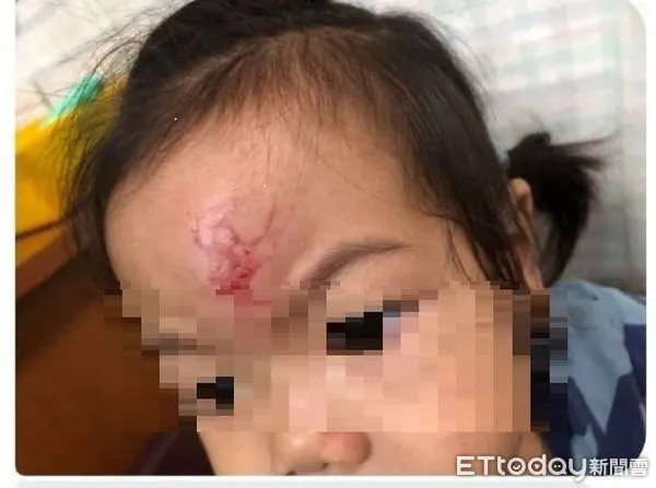▲台中十九甲健康公園隱藏危機，女孩玩耍竟摔頭腫大包。（圖／市議員江和樹提供）