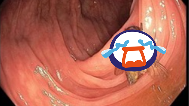 照大腸鏡驚見「活生生蒼蠅」到處爬！　他崩潰曝：都沒感覺 | ETtoday國際新聞 | ETtoday新聞雲