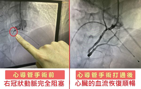 ▲▼病人右冠狀動脈完全阻塞，所幸手術成功救回一命。（圖／烏日林新醫院提供）