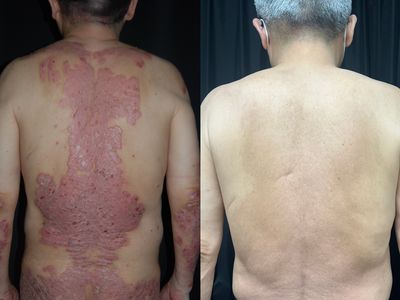 天冷吃薑母鴨補身體？乾癬患者不適用　醫：亂補恐讓病灶「夯起來」