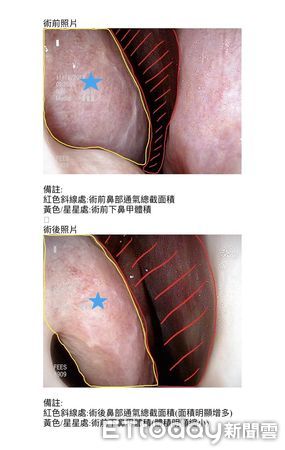 ▲▼   鼻部微創手術恢復暢快呼吸 。（圖／嘉義醫院提供）