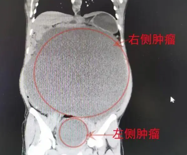 ▲23歲女子莫名大肚去就醫取出21公斤腫。（圖／攝自新聞晨報）