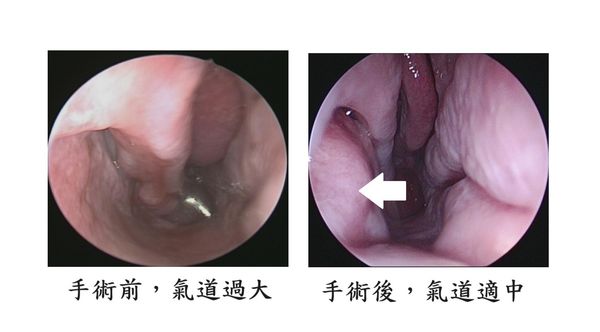 ▲▼空鼻症病患手術前（左圖）與手術後（右圖）鼻腔內視鏡影像，箭頭為手術重建部位。（圖／長庚醫院提供）