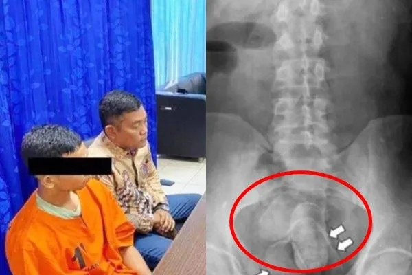 ▲▼馬來西亞一名男子將毒品塞入肛門走私到印尼。（圖／翻攝自印尼警方照片）