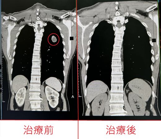 ▲▼患者咳嗽且痰帶血，檢查發現有肺膿瘍。（圖／烏日林新醫院提供）