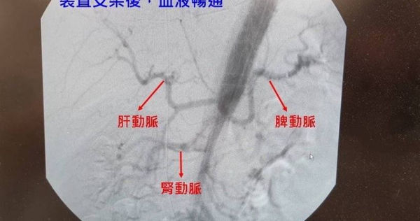 43歲男先腹痛再背痛　險喪命！一檢查竟是主動脈剝離