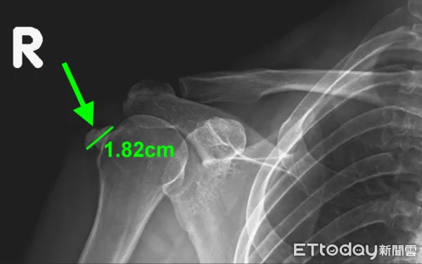 ▲施姓美甲師疑因長期姿勢不良及重複性動作，右肩罹患鈣化性肌腱病變。（圖／台中榮總埔里分院提供，下同）