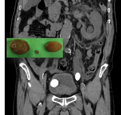 ▲▼一名患者泌尿道出現高爾夫球大結石。（圖／泌尿科醫師呂謹亨提供）