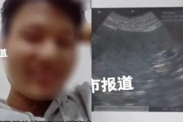 ▲男子謊稱睪丸破裂，騙取父親132萬元。（圖／翻攝自微博）