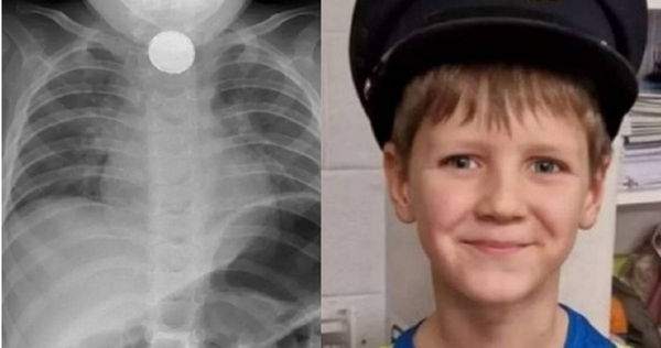 男童西考斯基（Aaron Sikorski）1歲1個月大時不慎吞下鈕扣電池。（圖／翻攝畫面）