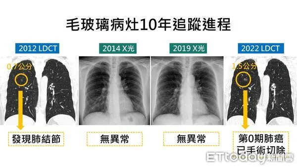 ▲病患追蹤肺結節，10年間2次X光檢查均未發現異狀，直到選擇重用LDCT後，發現原本的0.7公分肺結節已長到1.5公分大，確診0期肺癌。（圖／慈濟醫學中心提供，下同）