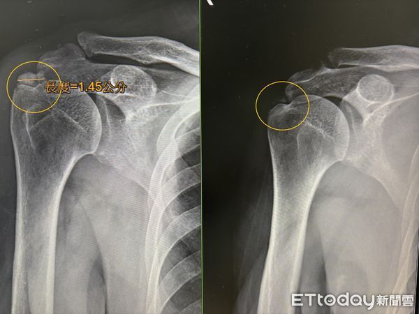 ▲經X光檢查，患者肩膀有一鈣化點(左圖)，經超音波導引注射抽吸治療後，鈣化點(右圖)明顯消失。（圖／記者許宥孺翻攝）