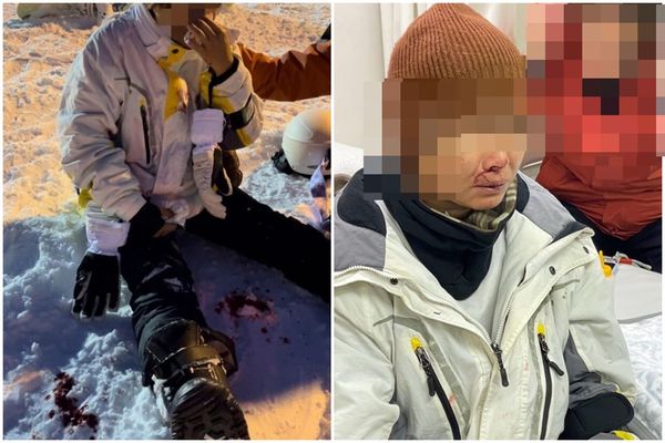 一名台灣女子在新潟雪場，被港女當場撞到濺血破相。（翻攝自記者爆料網、SNOWKON滑雪控）