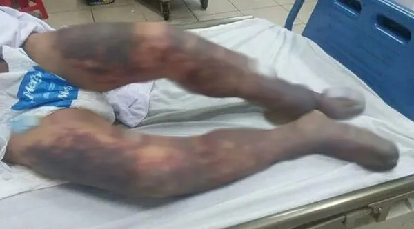 ▲▼越南一名男子在食用「黑布丁」後，因罹患豬鏈球菌感染而死。（圖／醫院提供）