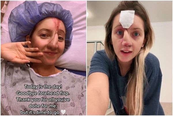 ▲▼美國賓州的26歲女子威爾遜（Jordan Wilson）被狗咬掉鼻子，經歷10次鼻部重建手術後，外觀才大致復原。（圖／翻攝自TikTok、IG／@sincerelyjord_）