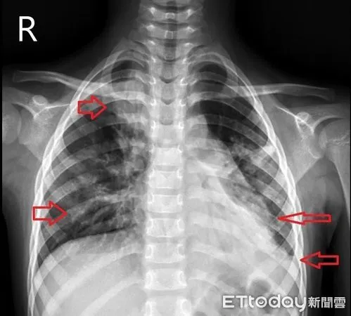 ▲遭腺病毒、A流雙夾殺！女童連8天高燒40度住進加護。（圖／中國附醫提供）