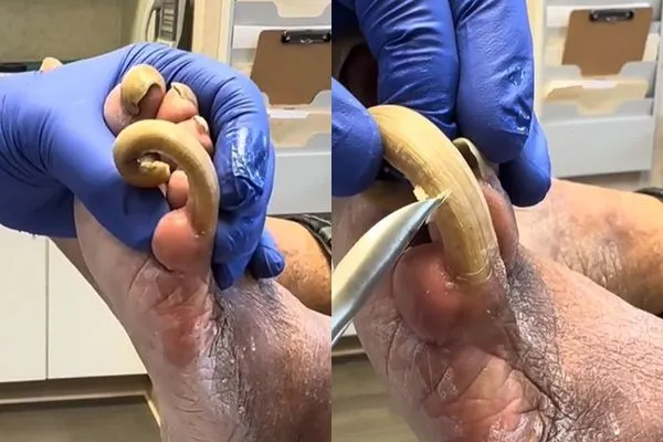 ▲▼大拇指扭曲變形！小拇指如「惡魔角」噁片曝光。（圖／翻攝自TikTok）