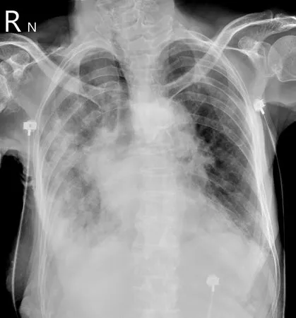 ▲▼ 蘇一峰在臉書PO出一張患者「大白肺」X光片。（圖／取自蘇一峰臉書）