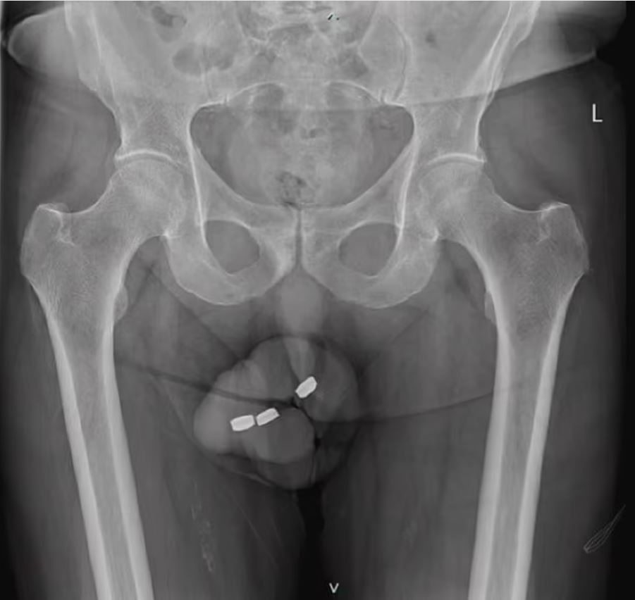 ▲▼73歲男DIY入珠「塞鈕扣電池」！陰莖壞死。（圖／Urology Case Reports）